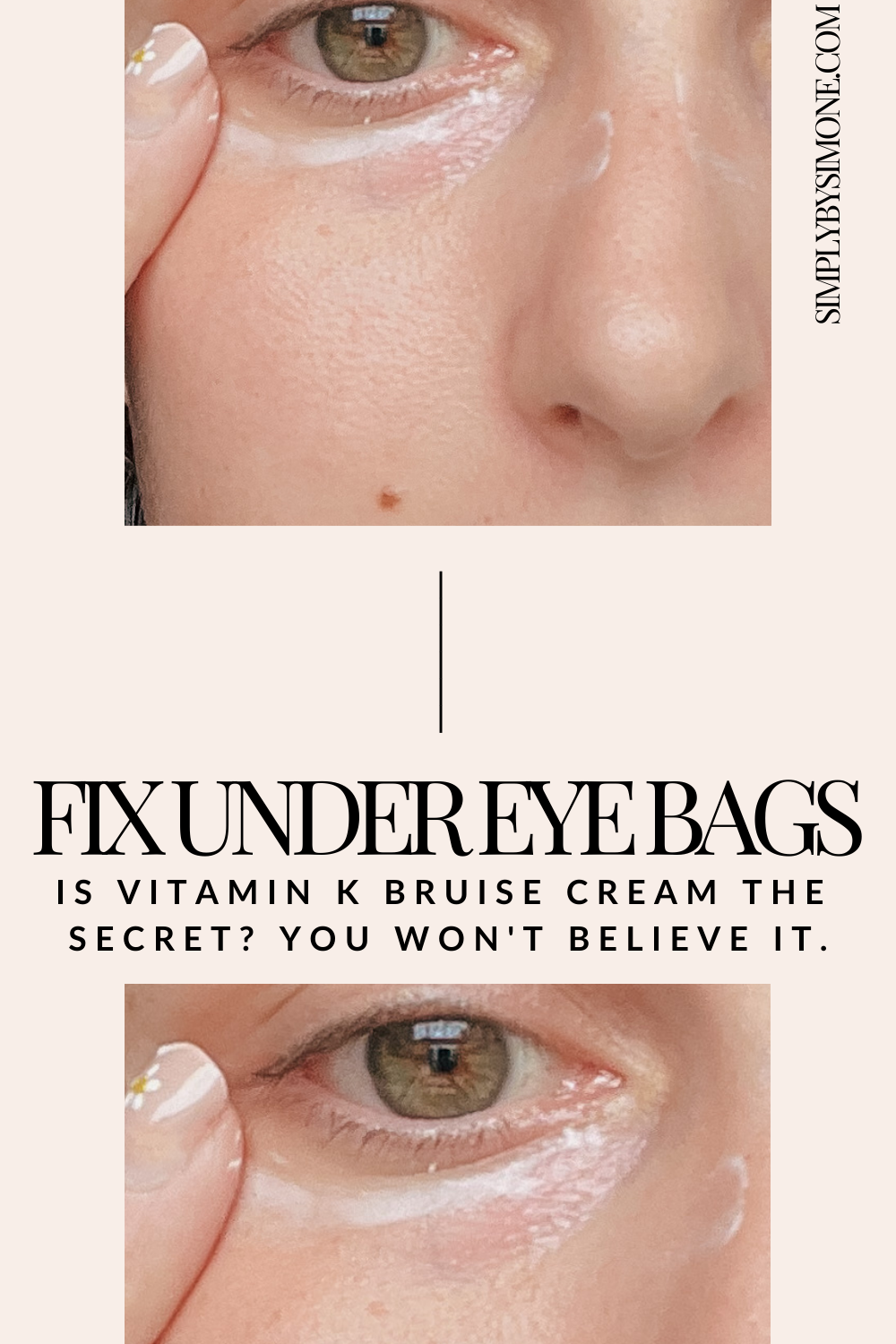 Will Vitamin K Get Rid Of Your Under-Eye Bags? You Won't Believe This
